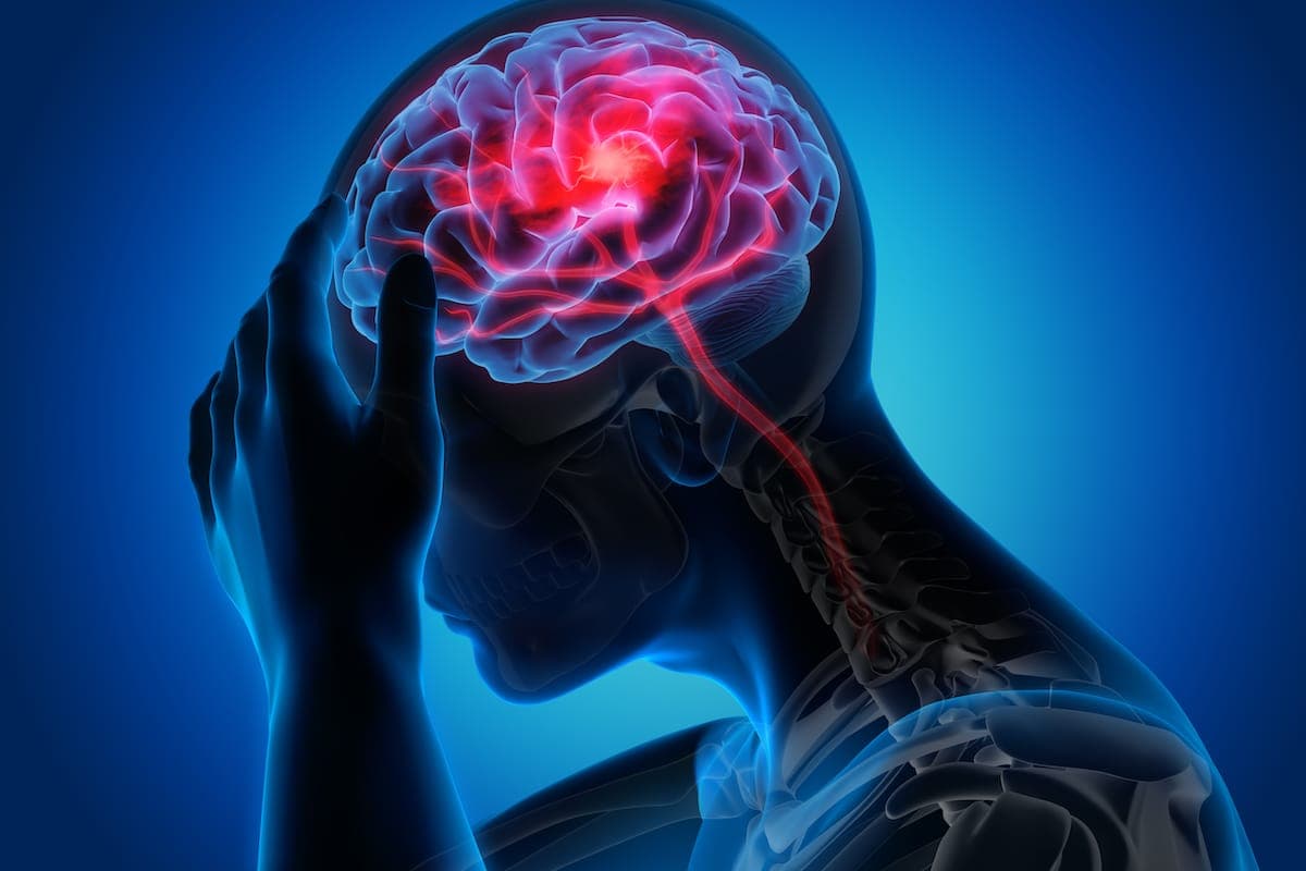 migraine