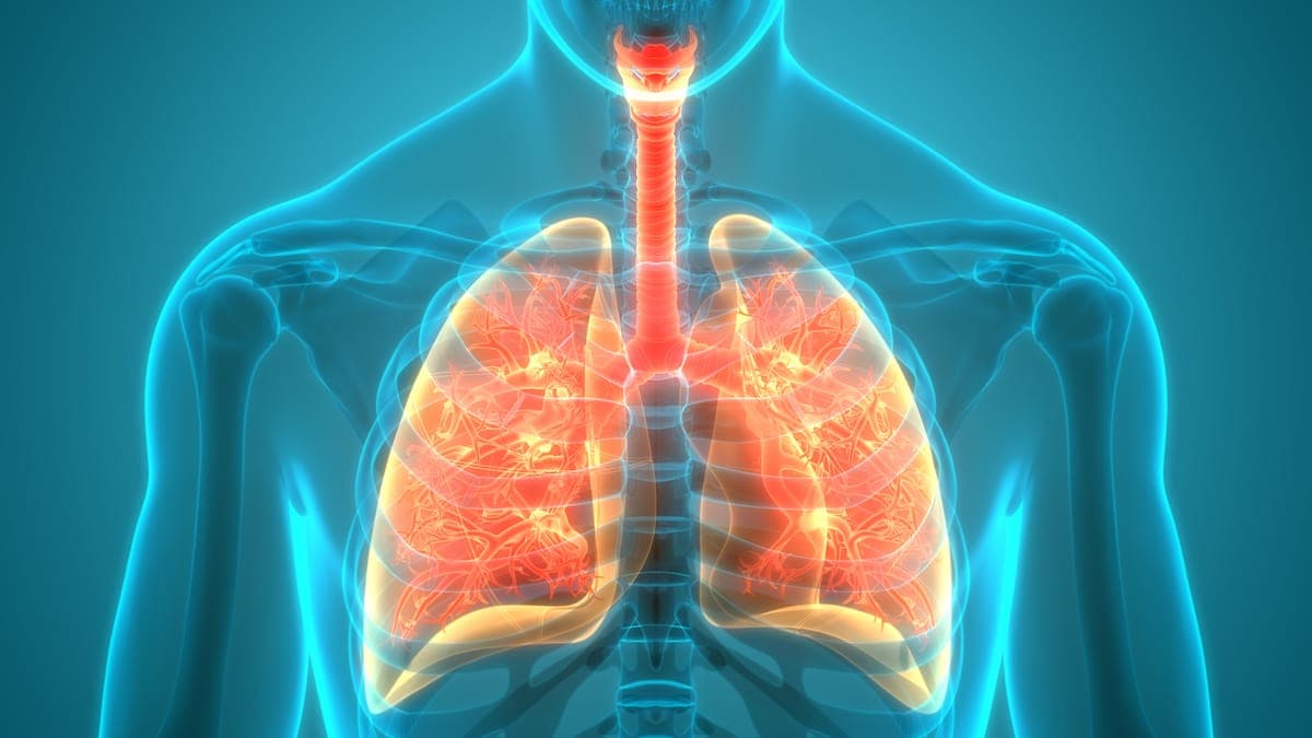 cystic fibrosis