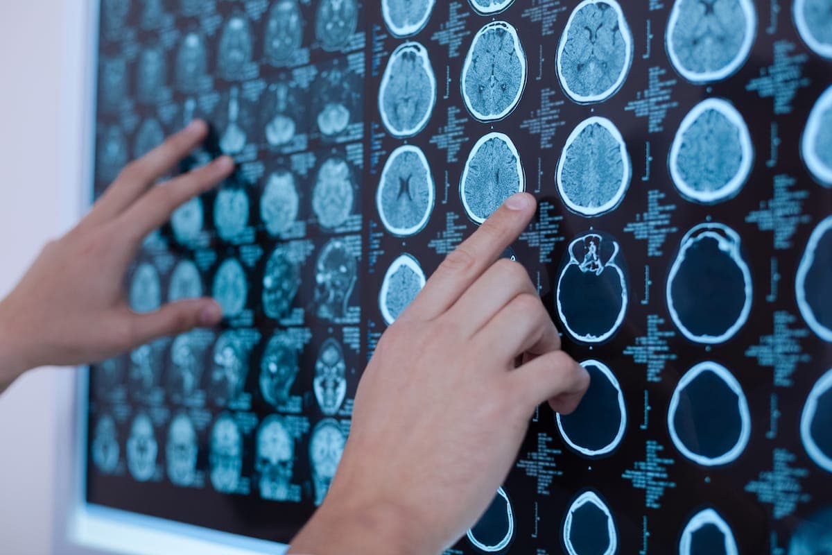 brain tumour