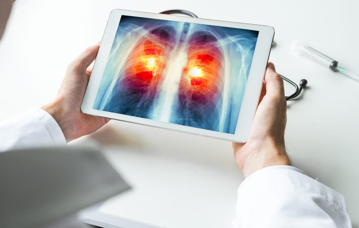 lung cancer