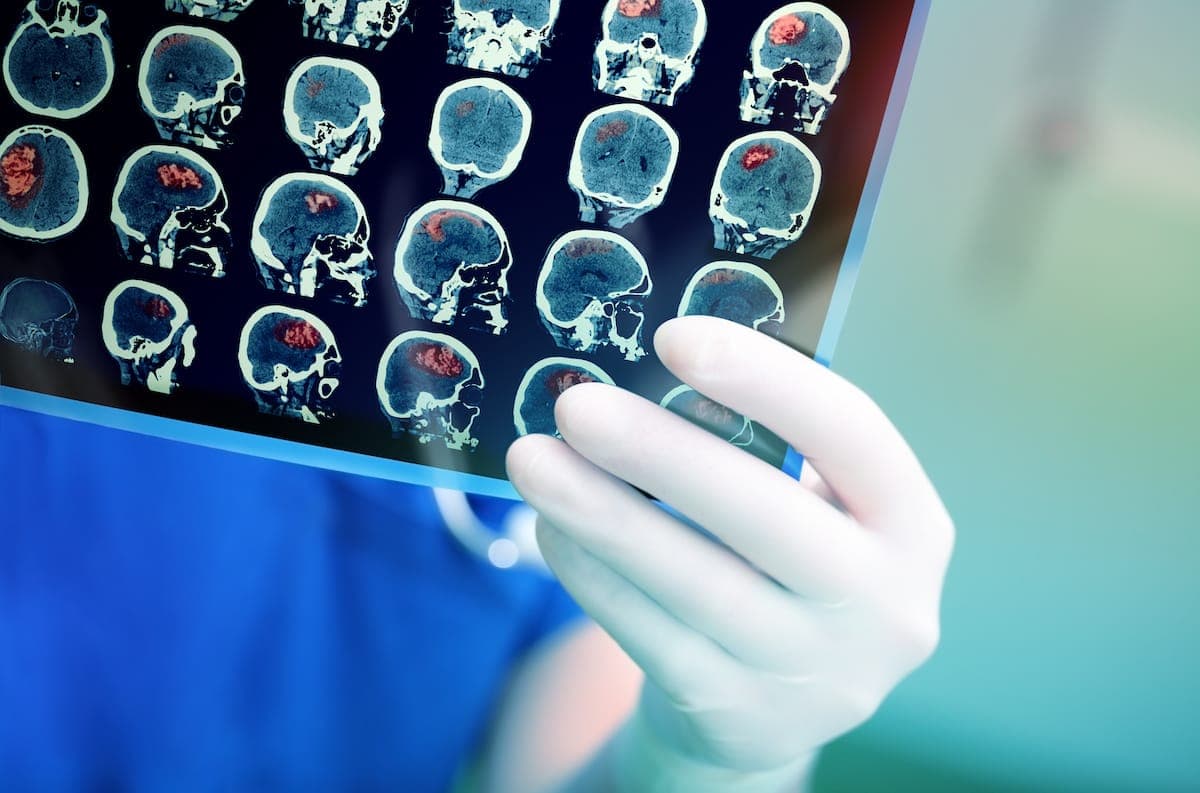 MRI of brain tumour
