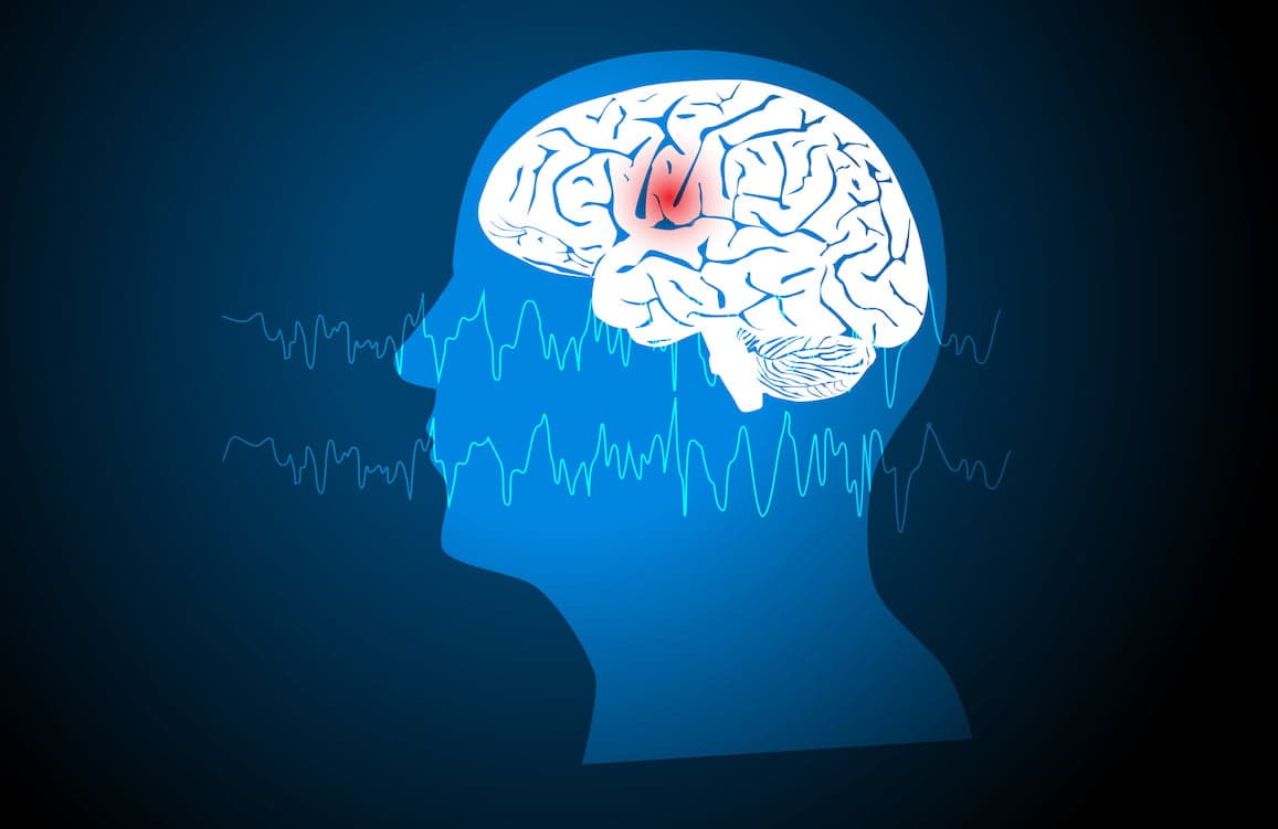 CBD gel reduces focal seizures by over 50% in epilepsy - study