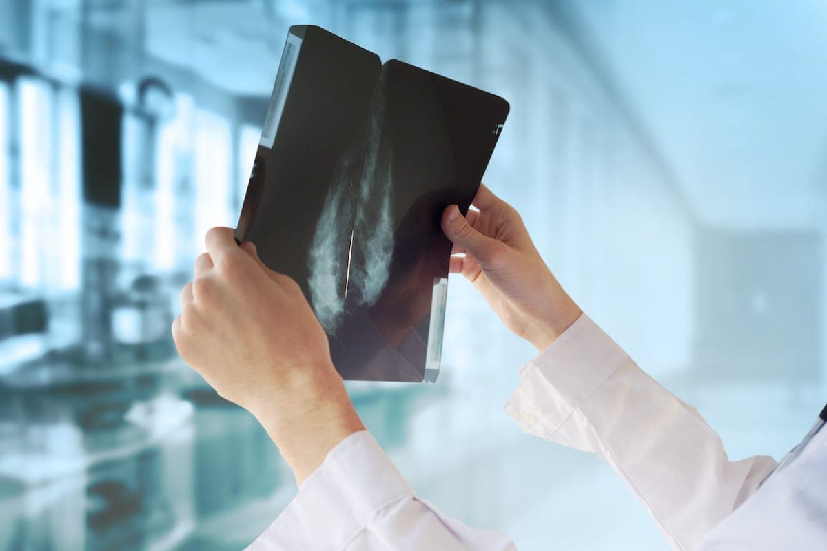 breast cancer scan