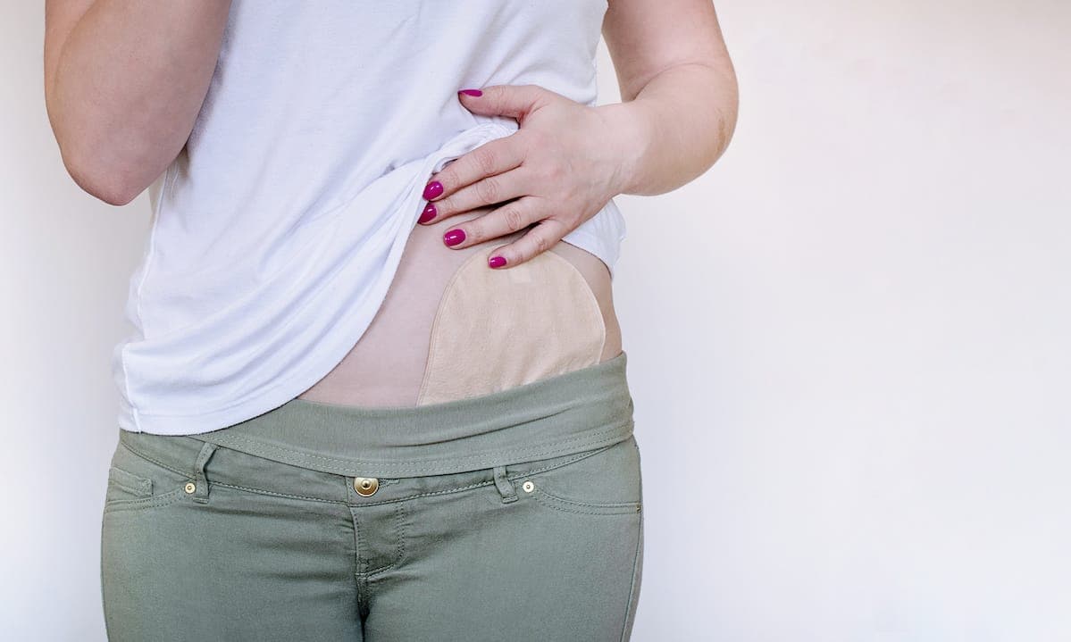 Crohns and colitis: Pat