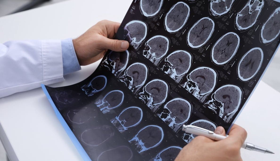 Research shows promise for medical cannabis and MS