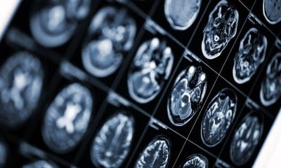 Dravet syndrome, seizures: MRI scan image of human head.
