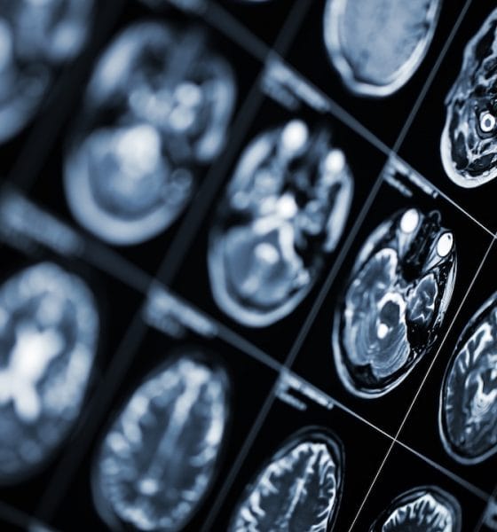 Dravet syndrome, seizures: MRI scan image of human head.